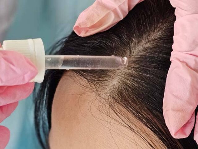 Regrow Naturally with Advanced Hair Restoration in Saraland AL